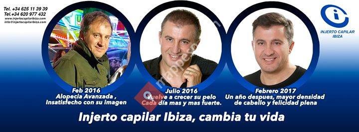 Injerto Capilar Ibiza